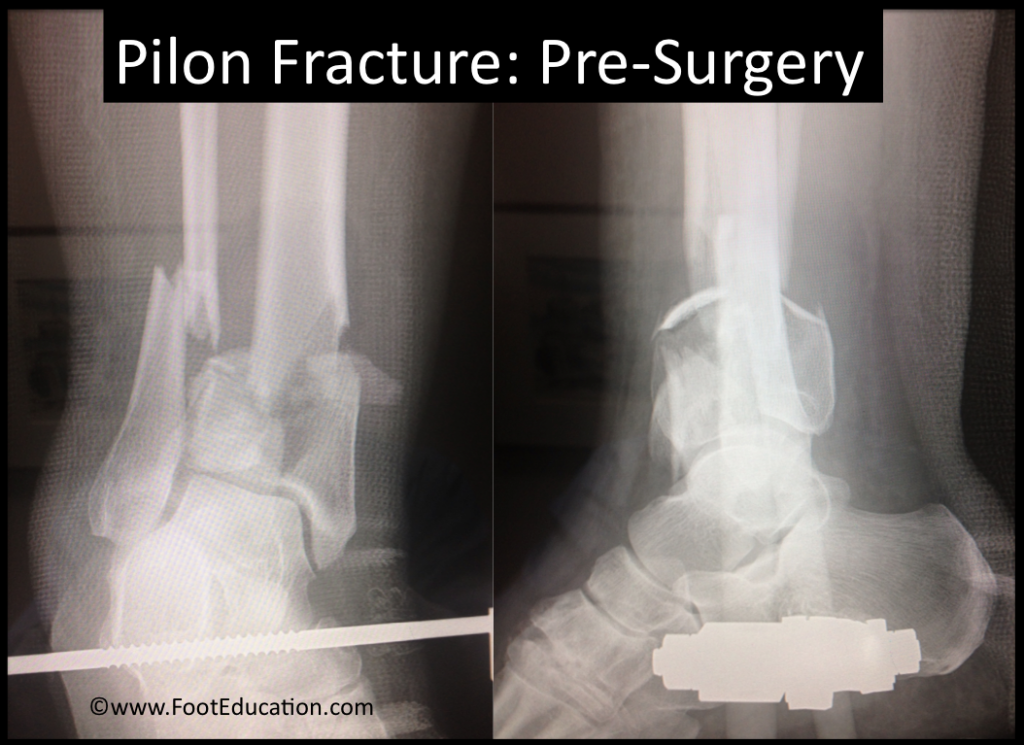 Pilon Fracture - FootEducation