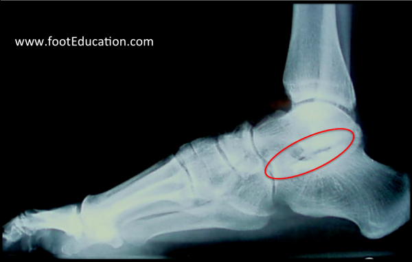 Subtalar Arthritis x-ray