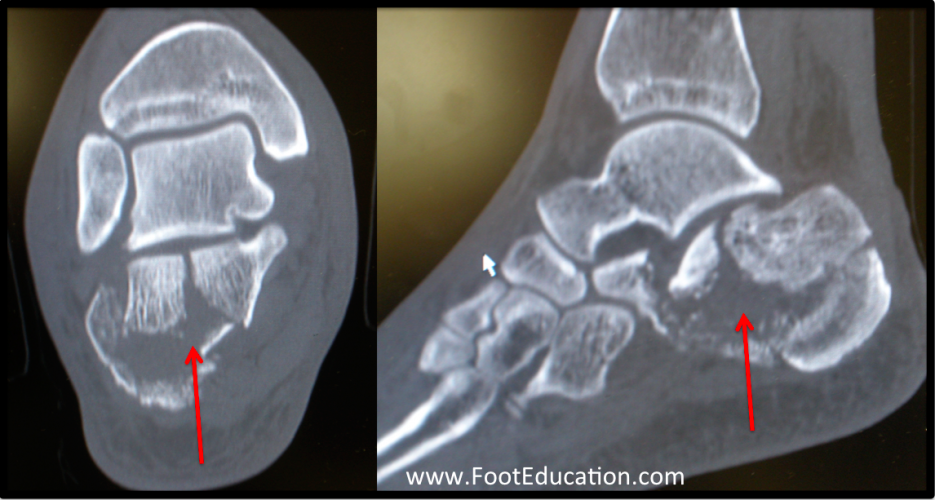 Calcaneal Fractures FootEducation