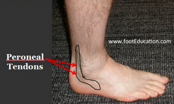 Location of pain and swelling in Peroneal Tendonitis