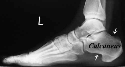 X-ray of foot showing a normal calcaneus from the side