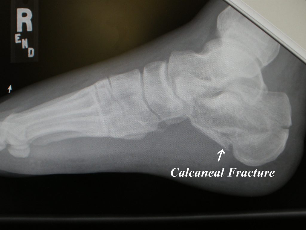 Calcaneal Fractures - FootEducation