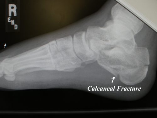 X-ray of a depressed calcaneus fracture