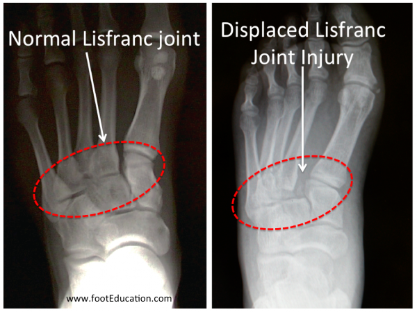 Normale Lisfranc vs Lisfranc-Fraktur