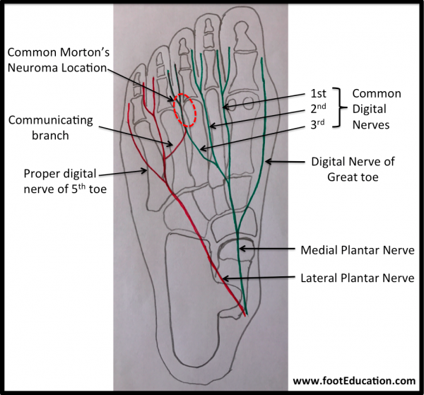 Toe Yoga and Neuromas Pt reported with left pain in between her 3rd and 4th  toes. Pain for > 6 months. So interesting when we asked