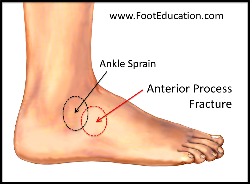 heel fracture treatment