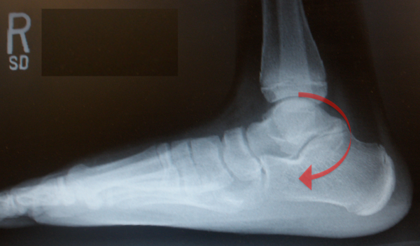 icd 10 code for right talocalcaneal coalition