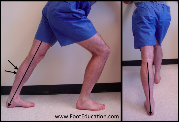 Plantar Fasciitis - FootEducation