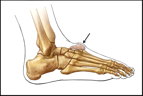 Ganglion cyst on foot: Pictures, cause, symptoms, and treatment