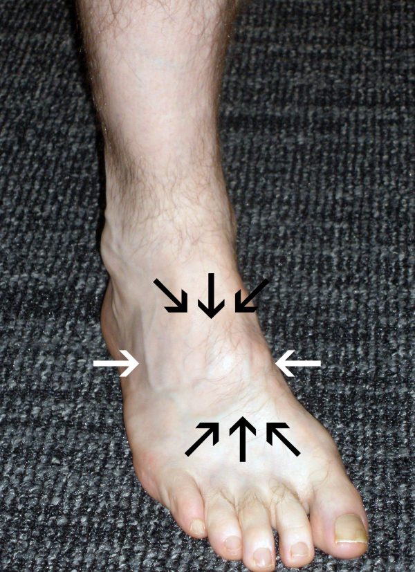 Lisfranc Localisation de la blessure de la douleur