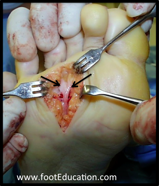 Location of nerve right under the skin, Mortons Neuroma