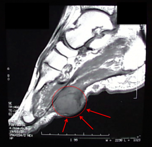 Plantar Fibroma - Footeducation