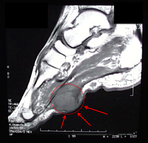 MRI of Large Plantar Fibroma