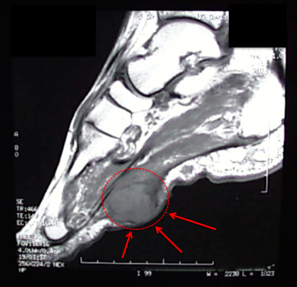 Plantar Fibroma Footeducation