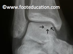 La Lesion Osteochondrale de L astragale FootEducation