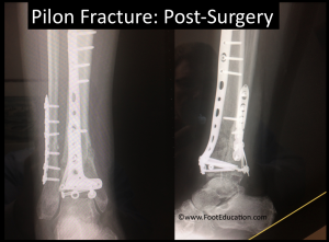 tibial pilon fracture recovery time
