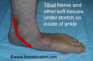 Repetitive Stretching of inner ankle region leading to tibial nerve irritation