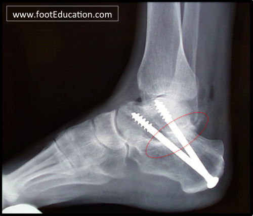 Subtalar Fusion on x-ray