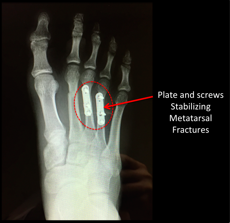 Broken Foot Metatarsal Fracture