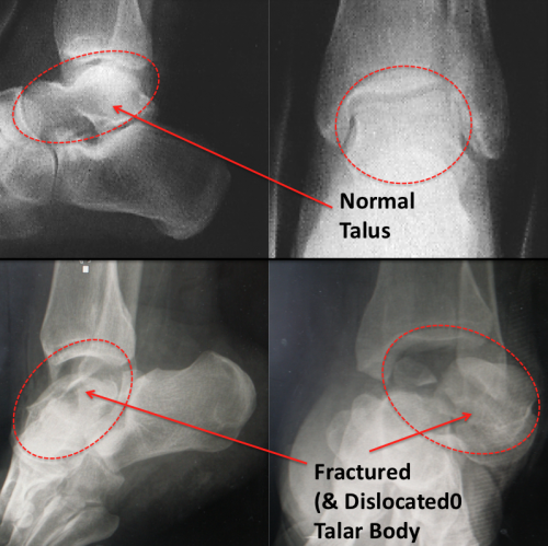 X-rays Normal vs Displaced Talar Body fracture
