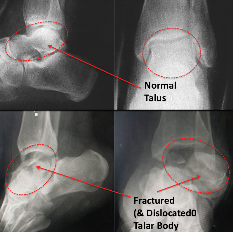 Talar Body Fracture Footeducation