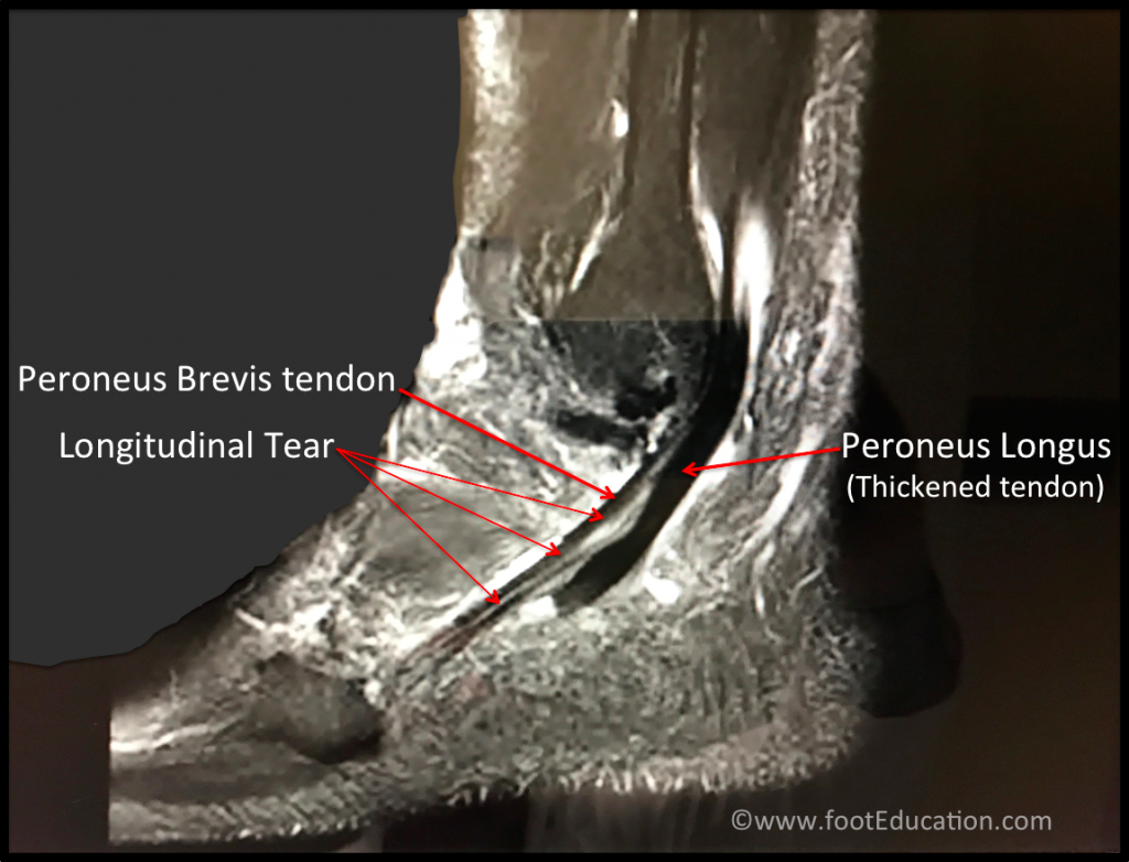 Pain After Peroneal Tendon Surgery TJHA