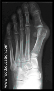 X-ray showing bunion