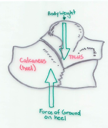 Mechanism of Typical Calcaneal fracture - Side view