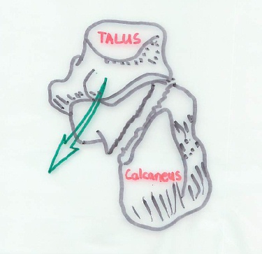 Mechanism of Typical Calcaneal fracture - Viewed from the back