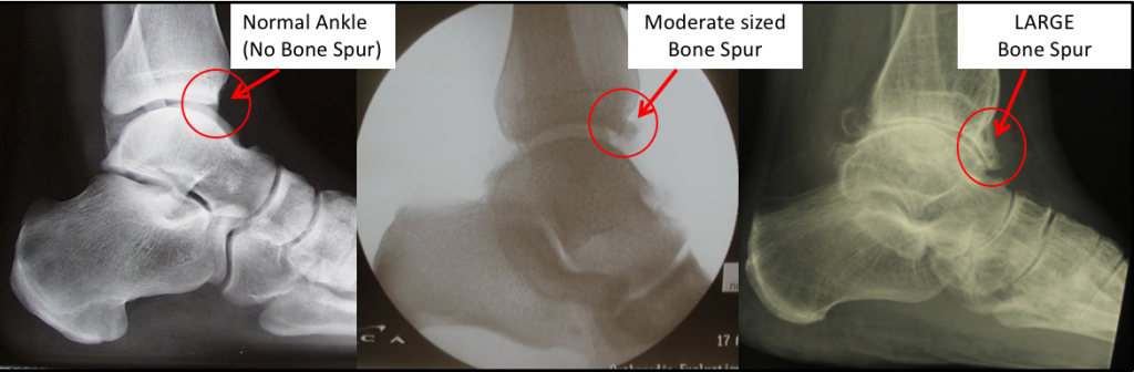 Anterior Ankle Impingement - FootEducation