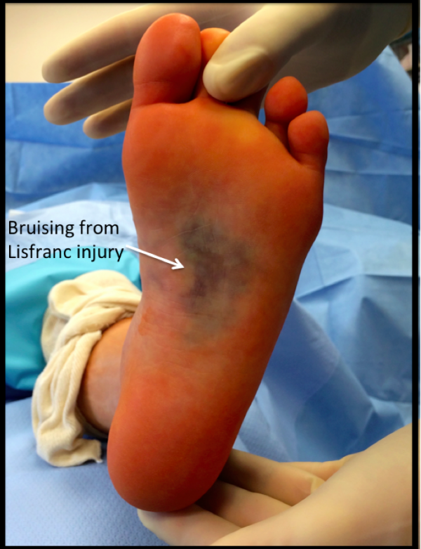 Bruising from Lisfranc Injury