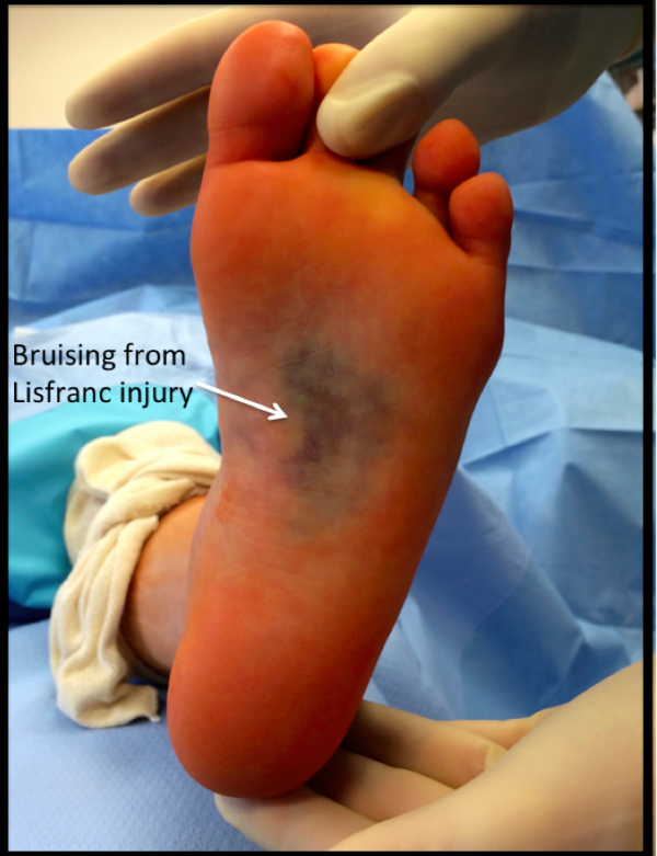 Hematomas por Lesión de Lisfranc