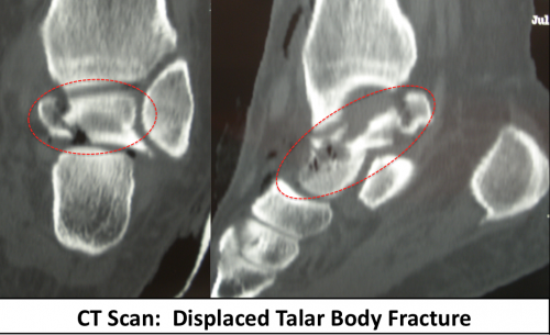 CT Scan Displaced Talar Body Fracture