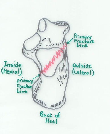 Calcaneal Fracture, Primary Fracture line viewed from the top (also showing secondary fracture lines)