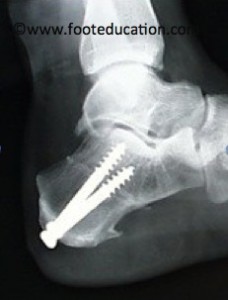 Calcaneal Osteotomy side view