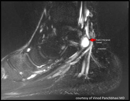 MRI showing a fluid-filled ganglion that is compressing the tibial nerve.