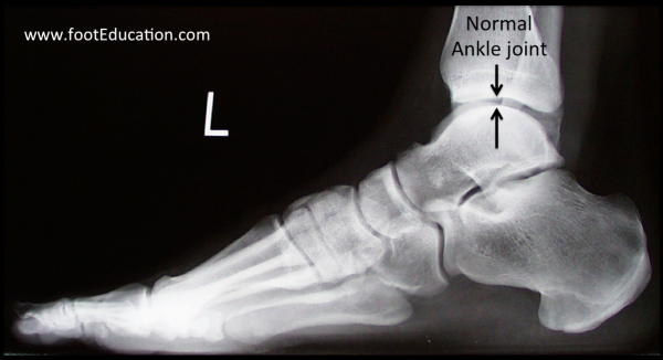 Normal ankle joint on x-ray