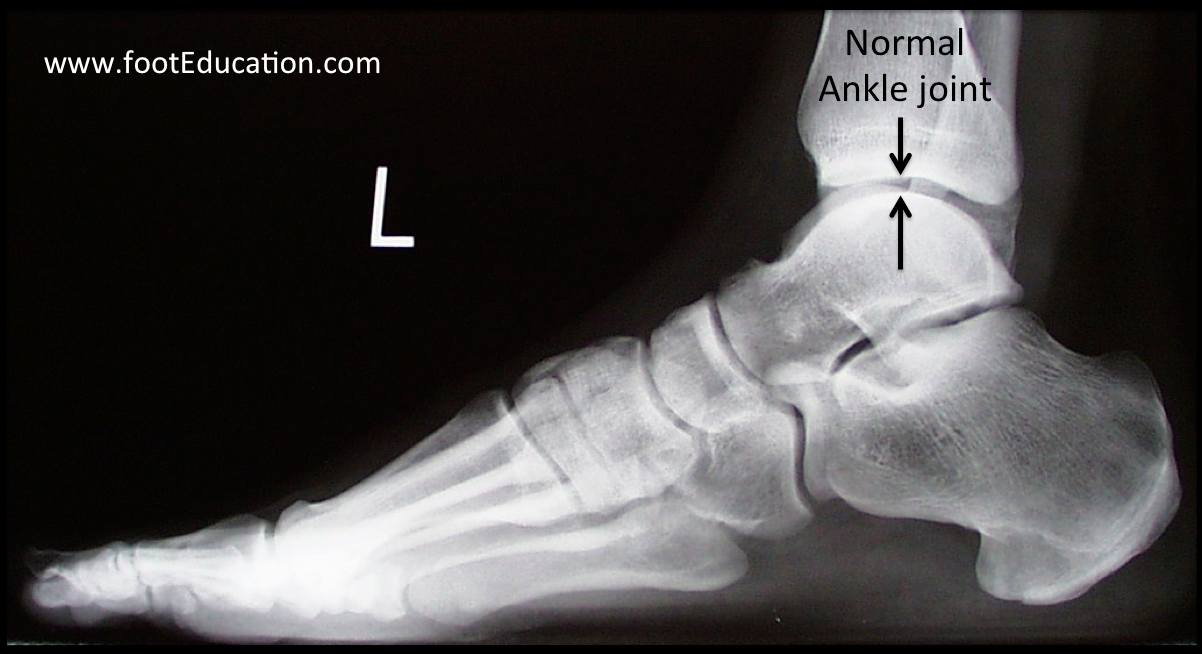 Figure 3 Normal Ankle Joint 