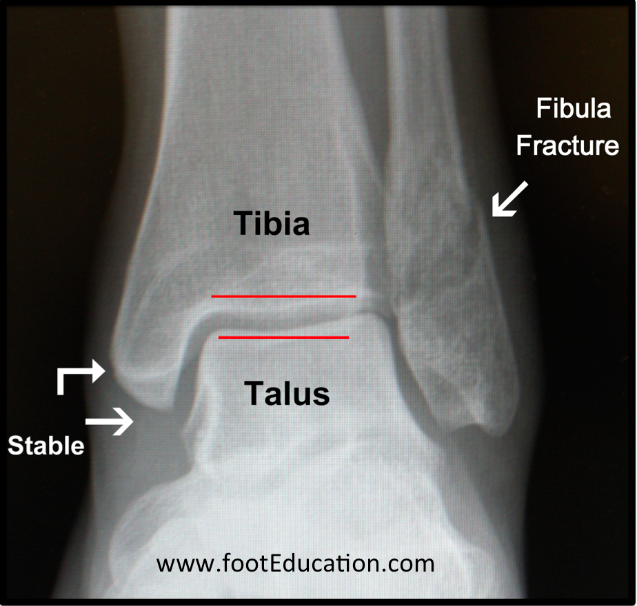distal fibula fracture