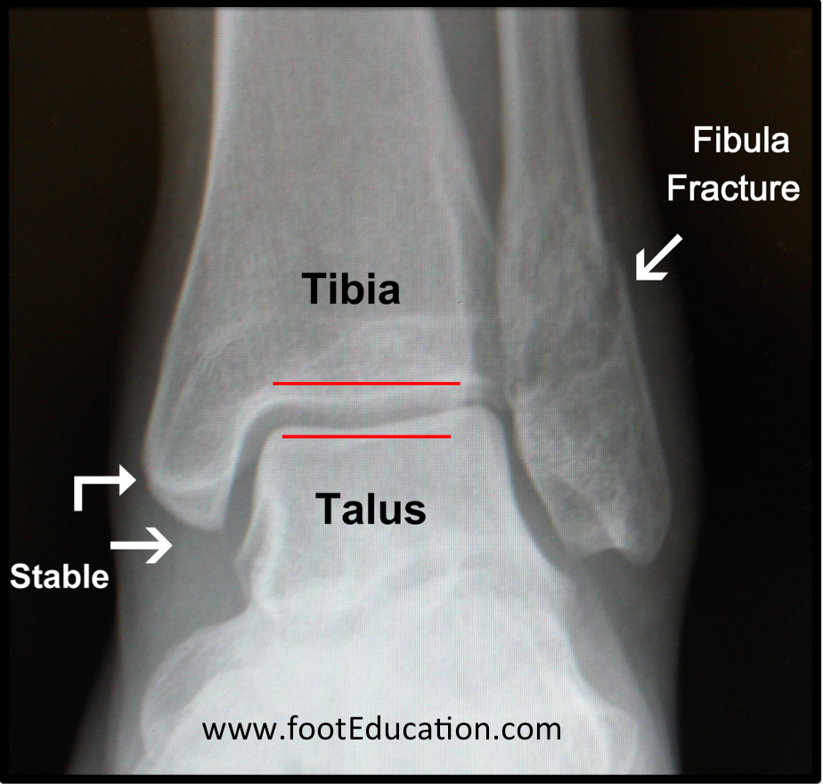 fractured fibula