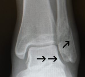 Twisting Mechanism of Injury ankle fracture