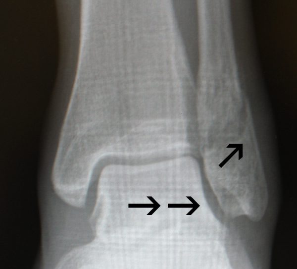 Stable Ankle Fracture - FootEducation