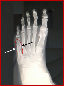 non displaced toe fracture