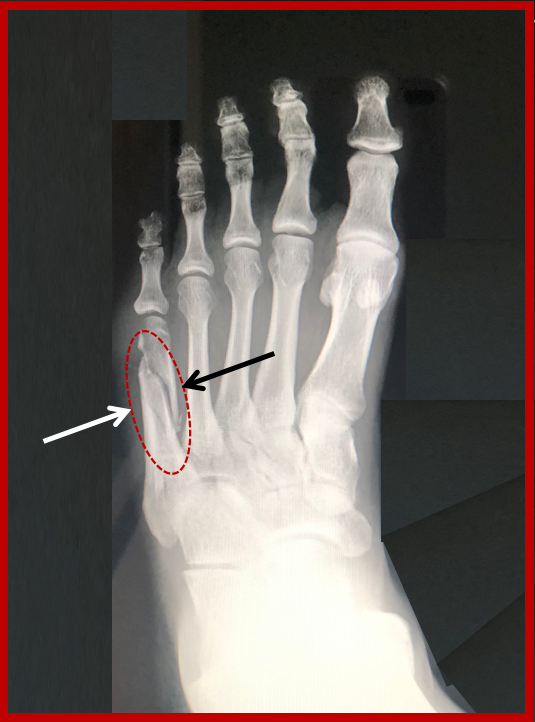 5th metatarsal fracture in child