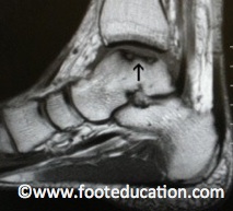 MRI Lateral (side) view of Talar OLT