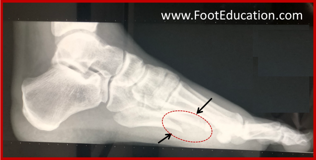5th metatarsal fracture recovery