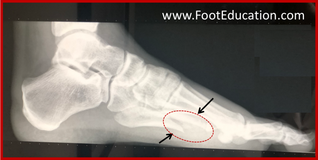 5th Metatarsal Shaft Dancer S Fracture Localizador