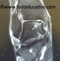 MRI Anteroposterior (view from front) of Talar OLT