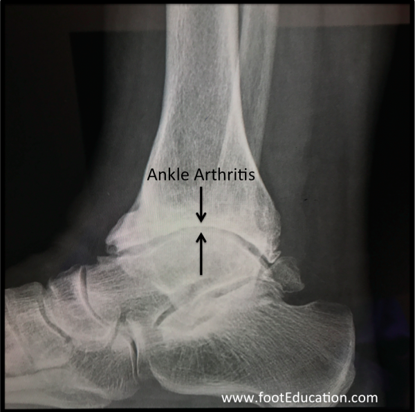 Severe Ankle Arthritis Lateral X-Ray