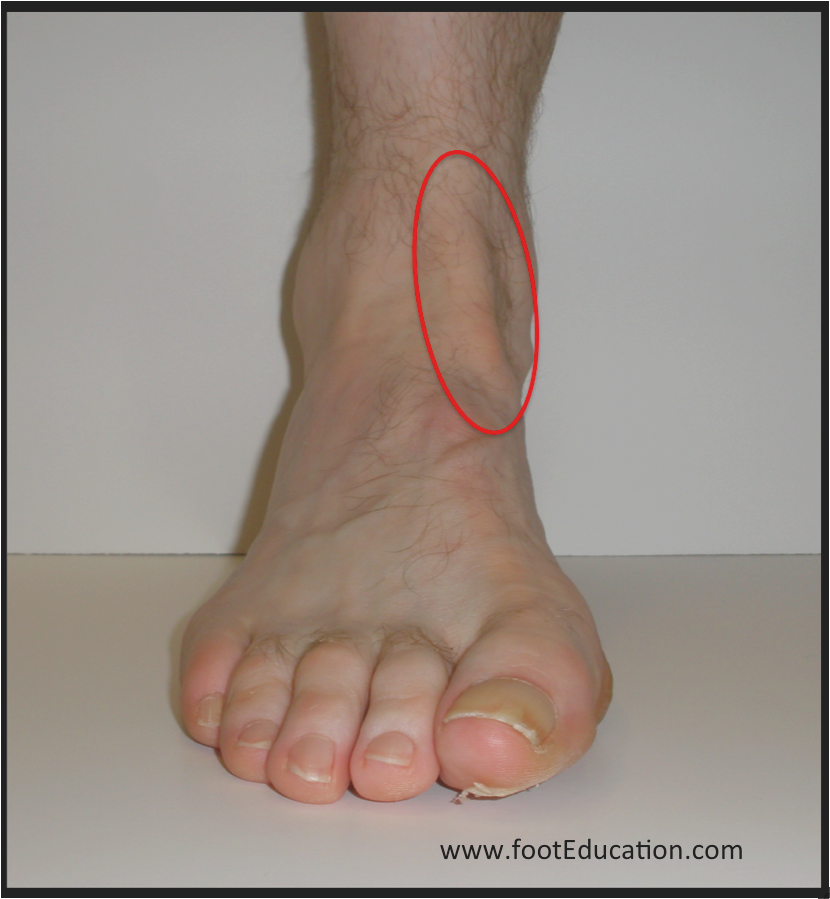 tibialis anterior muscle pain